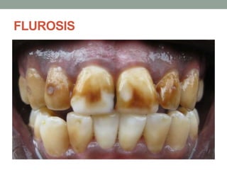 FLUROSIS
 