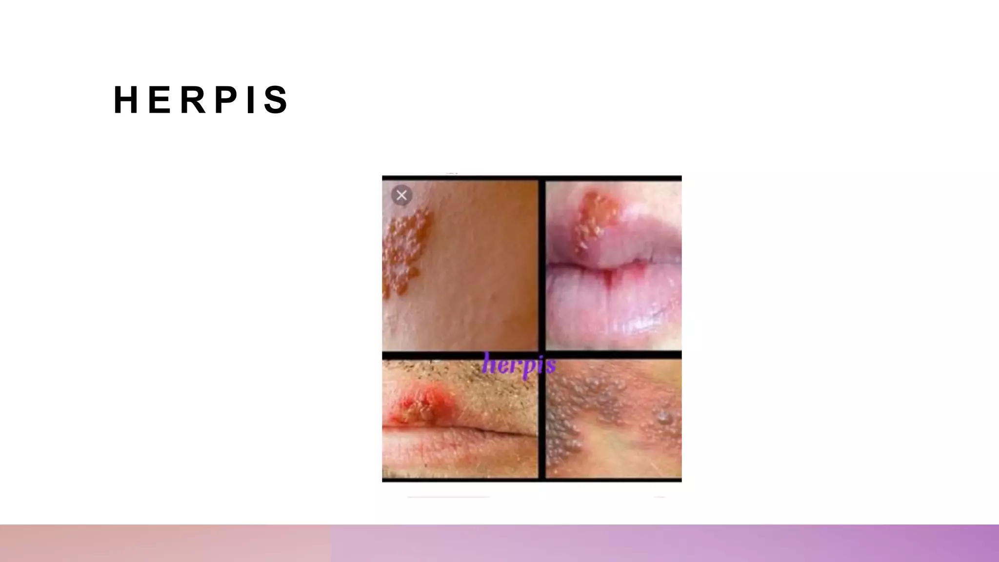 H E R P I S
 