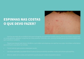 ESPINHAS NAS COSTAS
O QUE DEVO FAZER?
	 Espinhas nas costas são um problema sério para muita gente, principalmente na parte superior, próxima aos ombros, local que pos-
sui muitas glândulas sebáceas. As espinhas nas costas provocam incômodo e dor, causando também grande desconforto estético para
quem apresenta o problema.
	 Pessoas que possuem pele oleosa e tendência a acne estão mais propensas a ter espinhas nas costas, mas existem certos fatores
que contribuem, e que devem ser evitados:
•	 Tomar muito sol, que aumenta a oleosidade da pele;
•	 Usar blusas apertadas, que podem fechar os poros e provocar bolinhas vermelhas na pele, que evoluem para espinhas;
•	 Atrito do cabelo com as costas, principalmente quando possuem resíduos de produtos oleosos.
 