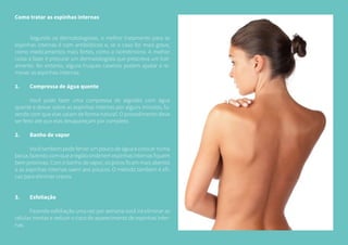 Como tratar as espinhas internas
	 Segundo os dermatologistas, o melhor tratamento para as
espinhas internas é com antibióticos e, se o caso for mais grave,
como medicamentos mais fortes, como a isotretinoina. A melhor
coisa a fazer é procurar um dermatologista que prescreva um trat-
amento. No entanto, alguns truques caseiros podem ajudar a re-
mover as espinhas internas:
1.	 Compressa de água quente
	 Você pode fazer uma compressa de algodão com água
quente e deixar sobre as espinhas internas por alguns minutos, fa-
zendo com que elas saiam de forma natural. O procedimento deve
ser feito até que elas desapareçam por completo.
2.	 Banho de vapor
	 Você também pode ferver um pouco de água e colocar numa
bacia,fazendocomquearegiãoondetemespinhasinternasfiquem
bem próximas. Com o banho de vapor, os poros ficam mais abertos
e as espinhas internas saem aos poucos. O método também é efi-
caz para eliminar cravos.
3.	Esfoliação
	 Fazendo esfoliação uma vez por semana você irá eliminar as
células mortas e reduzir o risco de aparecimento de espinhas inter-
nas.
 