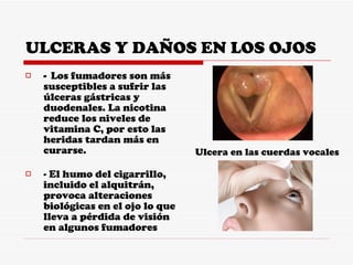 ULCERAS Y DAÑOS EN LOS OJOS -  Los fumadores son más susceptibles a sufrir las úlceras gástricas y duodenales. La nicotina reduce los niveles de vitamina C, por esto las heridas tardan más en curarse.  - El humo del cigarrillo, incluido el alquitrán, provoca alteraciones biológicas en el ojo lo que lleva a pérdida de visión en algunos fumadores  Ulcera en las cuerdas vocales 