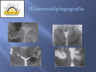 Histerossalpingografia
 