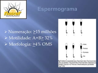  Numeração: >15 milhões
 Motilidade: A+B> 32%
 Morfologia: >4% OMS
 