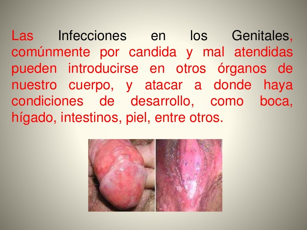 Porque Es Malo Soplar Los Genitales Como curar infecciones por hongos genitales