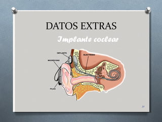 DATOS EXTRAS
  Implante coclear




                     31
 