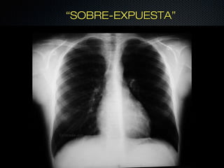 “SOBRE-EXPUESTA”
 