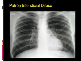 Patrón Intersticial Difuso
 