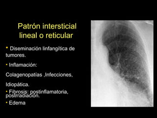 Patrón intersticial
     lineal o reticular
• Diseminación linfangítica de
tumores.
• Inflamación:
Colagenopatías ,Infecciones,
Idiopática.
• Fibrosis: postinflamatoria,
postrradiación.
• Edema
 