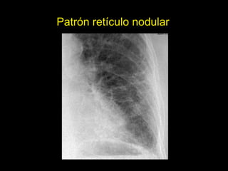 Patrón retículo nodular




                          38
 