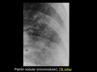 Patrón nodular (micronodular). TB miliar
             Nódulos finos. TBC diseminada
 