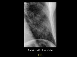 Patrón retículonodular
         FPI
 