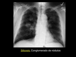 Silicosis. Conglomerado de nódulos
 