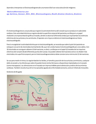 Aprende ainterpretarunElectrocardiogramade unamanerafácil con estacolecciónde imágenes
MedicinaMnemotecnias year
ago #arritmias, #corazon , #ECG , #EKG , #Electrocardiograma,#health,#medical ,#medicina,#medicine
El electrocardiogramaesunapruebaque registralaactividadeléctricadel corazónque se produce encadalatido
cardiaco.Esta actividadeléctricase registradesde lasuperficie corporal del pacienteyse dibujaenunpapel
mediante unarepresentacióngráficaotrazado,donde se observandiferentesondasque representanlosestímulos
eléctricosde lasaurículasy losventrículos.El aparato con el que se obtiene el electrocardiogramase llama
electrocardiógrafo.
Para la recogidade la actividadeléctricaporel electrocardiógrafo,se necesitaque sobre lapiel del paciente se
coloquenunaserie de electrodos(normalmente 10),que iránunidoshastael electrocardiógrafoporunoscables.Con
10 electrodosse consiguenobtener12 derivaciones,esdecir,se dibujanenel papel12 trazadosde losimpulsos
eléctricosdel corazóndesde diferentespuntosdel cuerpo.Se puedenobtenerderivacionesextrasi se añadenmás
electrodosala superficiecorporal,peroel electrocardiogramabásicodebe constarcomomínimode 12 derivaciones.
Se usa para medirel ritmoy la regularidadde loslatidos,el tamañoyposiciónde lasaurículasyventrículos,cualquier
daño al corazón y losefectosque sobre él puedentenerciertosfármacosodispositivosimplantadosenel corazón
(comomarcapasos).Las alteracionesenel trazadosonimprescindiblesparaladetecciónyanálisisde lasarritmias
cardiacas.Tambiénresultamuyútil enlosepisodiosagudosde enfermedadcoronaria,comoel infartode miocardio.
Síndrome de Brugada
 