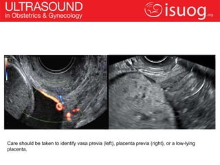 Care should be taken to identify vasa previa (left), placenta previa (right), or a low-lying
placenta.
 