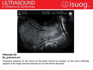 Videoclip S2:
Ex_pressure.avi
Excessive pressure on the cervix by the probe should be avoided, as the cervix artificially
appears to be longer and the presence of a funnel will be obscured.
 