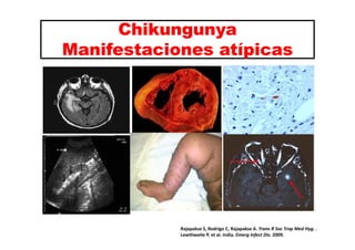 Chikungunya 
Manifestaciones atípicas 
Rajapakse S, Rodrigo C, Rajapakse A. Trans R Soc Trop Med Hyg. . 
Lewthwaite P, et ...