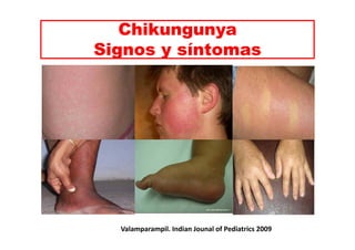 Chikungunya 
Signos y síntomas 
Valamparampil. Indian Jounal of Pediatrics 2009 
 