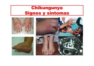 Chikungunya 
Signos y síntomas 
 