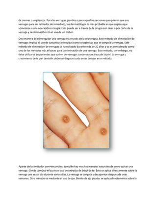de cremas o ungüentos. Para las verrugas grandes o para aquellas personas que quieren que sus
verrugas para ser retirados de inmediato, los dermatólogos lo más probable es que sugiera que
someterse a una operación o cirugía. Esto puede ser a través de la cirugía con láser o por corte de la
verruga y la eliminación con el uso de un bisturí.
Otra manera de cómo quitar una verruga es a través de la crioterapia. Este método de eliminación de
verrugas implica el uso de sustancias conocidas como criogénicos que se congela la verruga. Este
método de eliminación de verrugas se ha utilizado durante más de 20 años y ya es considerado como
uno de los métodos más eficaces para la eliminación de una verruga. Este método, sin embargo, no
debe utilizarse en pacientes que sufren de verrugas cancerosas o áreas de la piel. La verruga o
crecimiento de la piel también debe ser diagnosticada antes de usar este método.
Aparte de los métodos convencionales, también hay muchas maneras naturales de cómo quitar una
verruga. El más común y eficaz es el uso de extracto de árbol de té. Esto se aplica directamente sobre la
verruga una vez al día durante varios días. La verruga se congela y desaparece después de unas
semanas. Otro método es mediante el uso de ajo. Diente de ajo picado, se aplica directamente sobre la
 