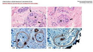 COMO SACARLE EL MEJOR PROVECHO A UNA BIOPSIA DE PIEL Reunión Sociedad Antioqueña de 
N 
EMA EMA 
N 
N 
N N 
Dermatología. Octubre 2014 
BIOPSIA PARCIAL QUE NO INCLUYE LA ARQUITECTURA GLOBAL. 
 