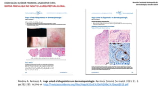 COMO SACARLE EL MEJOR PROVECHO A UNA BIOPSIA DE PIEL Reunión Sociedad Antioqueña de 
Dermatología. Octubre 2014 
BIOPSIA PARCIAL QUE NO INCLUYE LA ARQUITECTURA GLOBAL. 
Medina A. Restrepo R. Haga usted el diagnóstico en dermatopatología. Rev Asoc Colomb Dermatol. 2013; 21: 3. 
pp 212-213. Activo en http://revistasocolderma.org/files/Haga%20ud.%20el%20dx2%20sept2013.pdf 
 