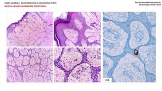 COMO SACARLE EL MEJOR PROVECHO A UNA BIOPSIA DE PIEL Reunión Sociedad Antioqueña de 
Dermatología. Octubre 2014 
BIOPSIA INADECUADAMENTE PROCESADA. 
CEA 
 