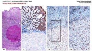 COMO SACARLE EL MEJOR PROVECHO A UNA BIOPSIA DE PIEL Reunión Sociedad Antioqueña de 
Dermatología. Octubre 2014 
BIOPSIA INADECUADAMENTE PROCESADA. 
PAS CK CD34 CD34 
 