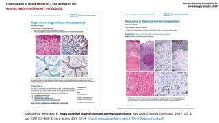 COMO SACARLE EL MEJOR PROVECHO A UNA BIOPSIA DE PIEL Reunión Sociedad Antioqueña de 
Dermatología. Octubre 2014 
BIOPSIA INADECUADAMENTE PROCESADA. 
Delgado V. Restrepo R. Haga usted el diagnóstico en dermatopatología. Rev Asoc Colomb Dermatol. 2012; 20: 4, 
pp 313/385-386. Enlace activo 29 X 2014 http://revistasocolderma.org/files/Diagnostico1.pdf 
 