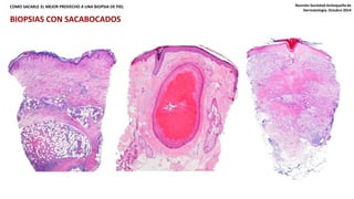 COMO SACARLE EL MEJOR PROVECHO A UNA BIOPSIA DE PIEL Reunión Sociedad Antioqueña de 
Dermatología. Octubre 2014 
BIOPSIAS CON SACABOCADOS 
 