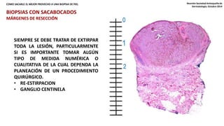 COMO SACARLE EL MEJOR PROVECHO A UNA BIOPSIA DE PIEL Reunión Sociedad Antioqueña de 
Dermatología. Octubre 2014 
BIOPSIAS CON SACABOCADOS 
MÁRGENES DE RESECCIÓN 
SIEMPRE SE DEBE TRATAR DE EXTIRPAR 
TODA LA LESIÓN, PARTICULARMENTE 
SI ES IMPORTANTE TOMAR ALGÚN 
TIPO DE MEDIDA NUMÉRICA O 
CUALITATIVA DE LA CUAL DEPENDA LA 
PLANEACIÓN DE UN PROCEDIMIENTO 
QUIRÚRGICO. 
• RE-ESTIRPACION 
• GANGLIO CENTINELA 
 