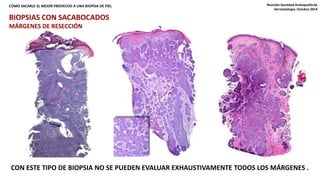 COMO SACARLE EL MEJOR PROVECHO A UNA BIOPSIA DE PIEL Reunión Sociedad Antioqueña de 
Dermatología. Octubre 2014 
BIOPSIAS CON SACABOCADOS 
MÁRGENES DE RESECCIÓN 
CON ESTE TIPO DE BIOPSIA NO SE PUEDEN EVALUAR EXHAUSTIVAMENTE TODOS LOS MÁRGENES . 
 