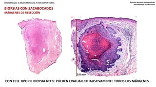 COMO SACARLE EL MEJOR PROVECHO A UNA BIOPSIA DE PIEL Reunión Sociedad Antioqueña de 
Dermatología. Octubre 2014 
BIOPSIAS CON SACABOCADOS 
MÁRGENES DE RESECCIÓN 
CON ESTE TIPO DE BIOPSIA NO SE PUEDEN EVALUAR EXHAUSTIVAMENTE TODOS LOS MÁRGENES . 
 