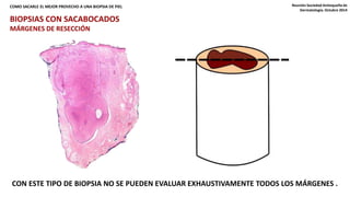 COMO SACARLE EL MEJOR PROVECHO A UNA BIOPSIA DE PIEL Reunión Sociedad Antioqueña de 
Dermatología. Octubre 2014 
BIOPSIAS CON SACABOCADOS 
MÁRGENES DE RESECCIÓN 
CON ESTE TIPO DE BIOPSIA NO SE PUEDEN EVALUAR EXHAUSTIVAMENTE TODOS LOS MÁRGENES . 
 