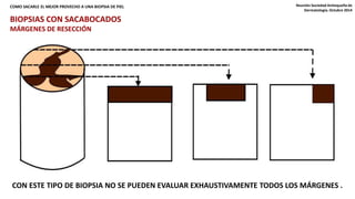 COMO SACARLE EL MEJOR PROVECHO A UNA BIOPSIA DE PIEL Reunión Sociedad Antioqueña de 
Dermatología. Octubre 2014 
BIOPSIAS CON SACABOCADOS 
MÁRGENES DE RESECCIÓN 
CON ESTE TIPO DE BIOPSIA NO SE PUEDEN EVALUAR EXHAUSTIVAMENTE TODOS LOS MÁRGENES . 
 