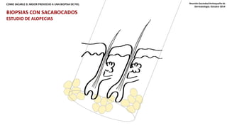 LA MANERA COMO SE TOME LA BIOPSIA INFLUYE EN SU PROCESO COMO SACARLE EL MEJOR PROVECHO A UNA BIOPSIA DE PIEL Y DIAGNÓSTICO Reunión Sociedad Antioqueña de 
Dermatología. Octubre 2014 
BIOPSIAS CON SACABOCADOS 
ESTUDIO DE ALOPECIAS 
 