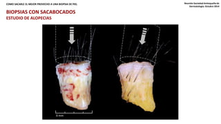 COMO SACARLE EL MEJOR PROVECHO A UNA BIOPSIA DE PIEL Reunión Sociedad Antioqueña de 
LA MANERA COMO SE TOME LA BIOPSIA INFLUYE EN SU PROCESO Y DIAGNÓSTICO 
4 mm 
Dermatología. Octubre 2014 
BIOPSIAS CON SACABOCADOS 
ESTUDIO DE ALOPECIAS 
 