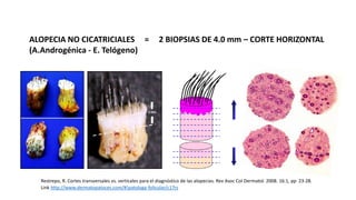 ALOPECIA NO CICATRICIALES = 2 BIOPSIAS DE 4.0 mm – CORTE HORIZONTAL 
(A.Androgénica - E. Telógeno) 
2 mm 
Restrepo, R. Cortes transversales vs. verticales para el diagnóstico de las alopecias. Rev Asoc Col Dermatol. 2008. 16:1, pp 23-28. 
Link http://www.dermatopatoces.com/#!patologa-folicular/c17rs 
 