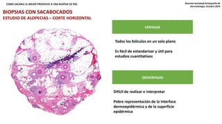 ¿QUÉ TIPO DE CORTE USAR: VERTICAL, COMO SACARLE EL MEJOR PROVECHO A UNA BIOPSIA D EH OPRIEIZLONTAL, AMBOS? Reunión Sociedad Antioqueña de 
VENTAJAS 
Todos los folículos en un solo plano 
Es fácil de estandarizar y útil para 
estudios cuantitativos 
DESVENTAJAS 
Difícil de realizar e interpretar 
Pobre representación de la interface 
dermoepidérmica y de la superficie 
epidérmica 
Dermatología. Octubre 2014 
BIOPSIAS CON SACABOCADOS 
ESTUDIO DE ALOPECIAS – CORTE HORIZONTAL 
 