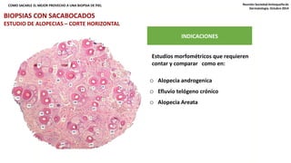 COMO SACARLE EL MEJOR PROVECHO A UNA BIOPSIA DE PIEL Reunión Sociedad Antioqueña de 
¿QUÉ TIPO DE CORTE USAR: VERTICAL, HORIZONTAL, AMBOS? 
INDICACIONES 
Estudios morfométricos que requieren 
contar y comparar como en: 
o Alopecia androgenica 
o Efluvio telógeno crónico 
o Alopecia Areata 
Dermatología. Octubre 2014 
BIOPSIAS CON SACABOCADOS 
ESTUDIO DE ALOPECIAS – CORTE HORIZONTAL 
 