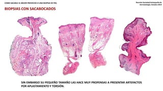 COMO SACARLE EL MEJOR PROVECHO A UNA BIOPSIA DE PIEL Reunión Sociedad Antioqueña de 
Dermatología. Octubre 2014 
BIOPSIAS CON SACABOCADOS 
SIN EMBARGO SU PEQUEÑO TAMAÑO LAS HACE MUY PROPENSAS A PRESENTAR ARTEFACTOS 
POR APLASTAMIENTO Y TORSIÓN. 
 