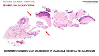 COMO SACARLE EL MEJOR PROVECHO A UNA BIOPSIA DE PIEL Reunión Sociedad Antioqueña de 
Dermatología. Octubre 2014 
BIOPSIAS CON SACABOCADOS 
IGUALMENTE CUANDO SE USAN SACABOCADOS YA USADOS QUE NO CORTAN ADECUADAMENTE 
 