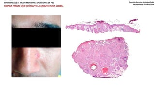 COMO SACARLE EL MEJOR PROVECHO A UNA BIOPSIA DE PIEL Reunión Sociedad Antioqueña de 
Dermatología. Octubre 2014 
BIOPSIA PARCIAL QUE NO INCLUYE LA ARQUITECTURA GLOBAL. 
 