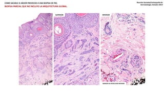 COMO SACARLE EL MEJOR PROVECHO A UNA BIOPSIA DE PIEL Reunión Sociedad Antioqueña de 
SUPERIOR INFERIOR 
MARGEN DE RESECCION INFERIOR 
Dermatología. Octubre 2014 
BIOPSIA PARCIAL QUE NO INCLUYE LA ARQUITECTURA GLOBAL. 
 