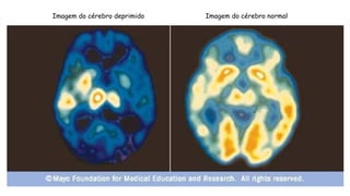 Imagem do cérebro deprimido Imagem do cérebro normal
 