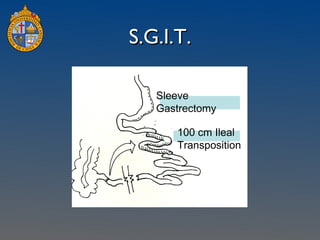S.G.I.T. 100 cm Ileal Transposition Sleeve Gastrectomy 