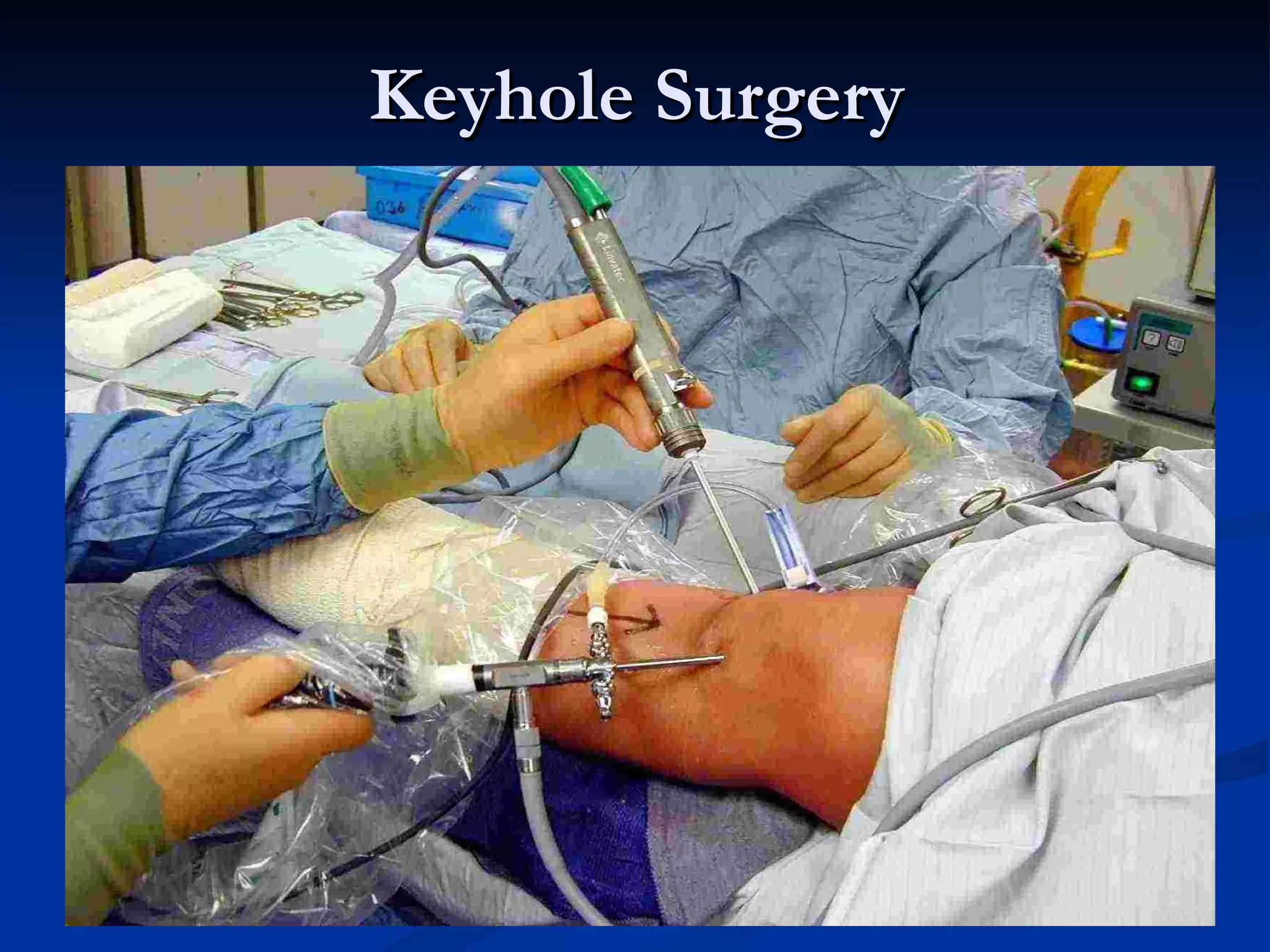 Keyhole Surgery 