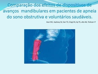 Comparação dos efeitos de dispositivos de
avanços mandibulares em pacientes de apneia
do sono obstrutiva e voluntários saudáveis.
Acar M1, Saylisoy S2, San T3, Cingi C4, Ay Y5, alto A6, Türkcan I7
 