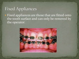  Fixed appliances are those that are fitted onto
the tooth surface and can only be removed by
the operator.
 