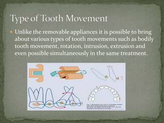  Unlike the removable appliances it is possible to bring
about various types of tooth movements such as bodily
tooth movement, rotation, intrusion, extrusion and
even possible simultaneously in the same treatment.
 