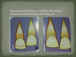 Intrusion and Extrusion- it refers to the vertical
movements of teeth along their long axis
 
